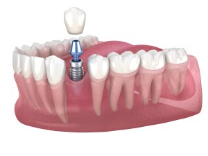 dental implant animation
