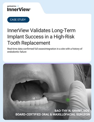 InnerView Validates Long-Term Implant Success in a High-Risk Tooth Replacement case study